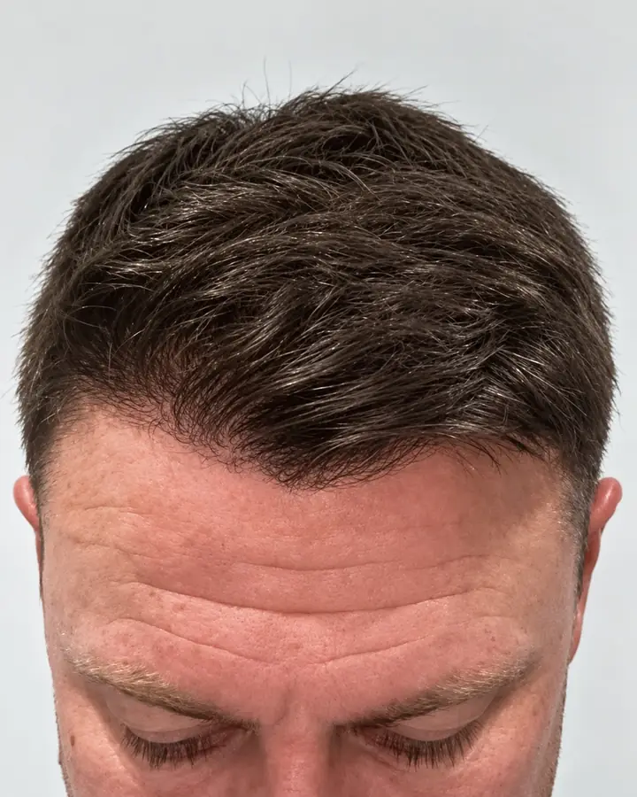 Hairline, after the transplant