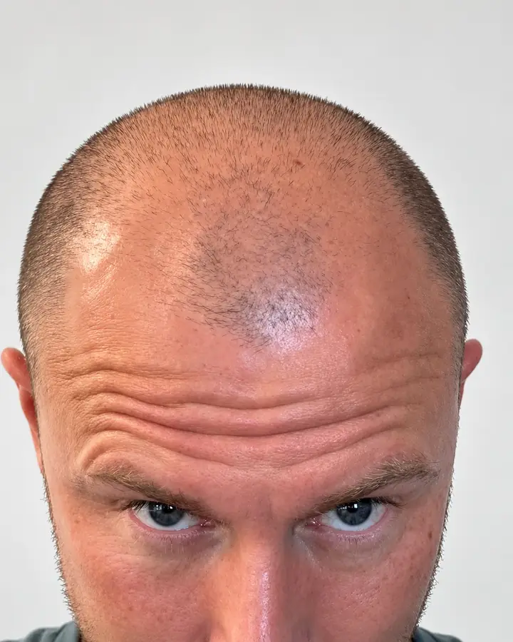Hairline, before the transplant