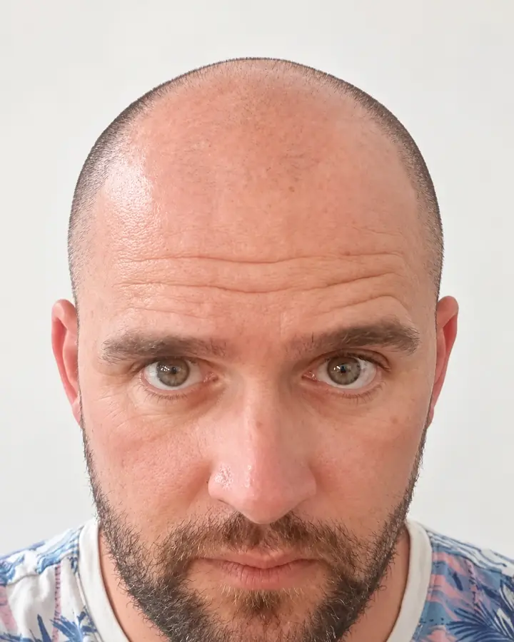 Hairline and temples, before the transplant