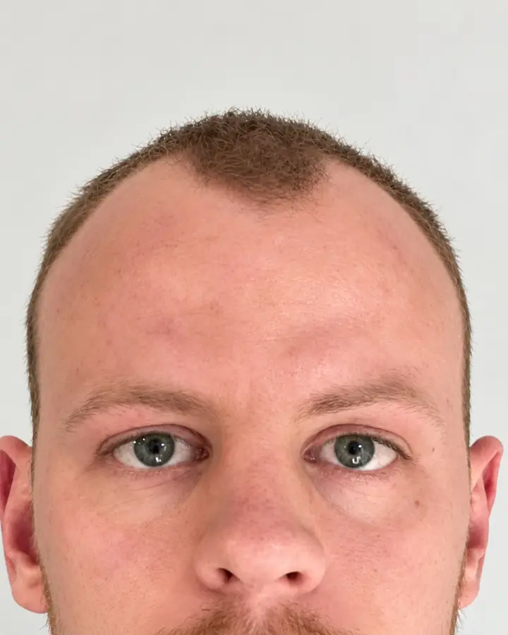 Significant loss, before the transplant