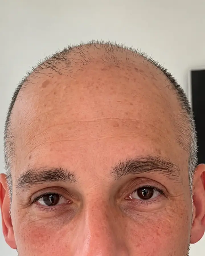 Receding temples, before the transplant