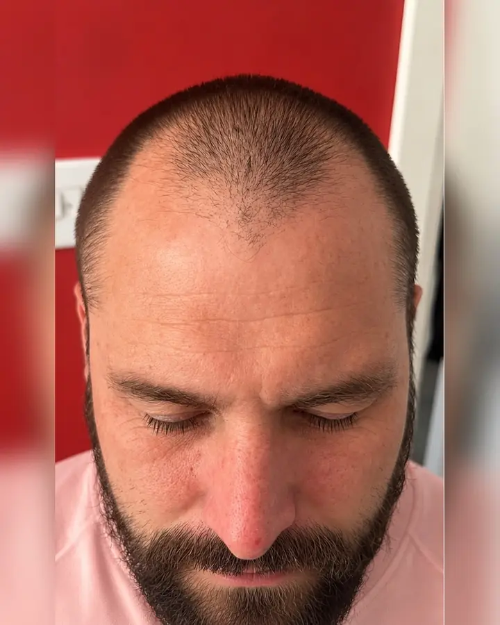 Crown, before the transplant