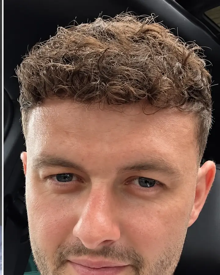 Hairline and crown, after the transplant