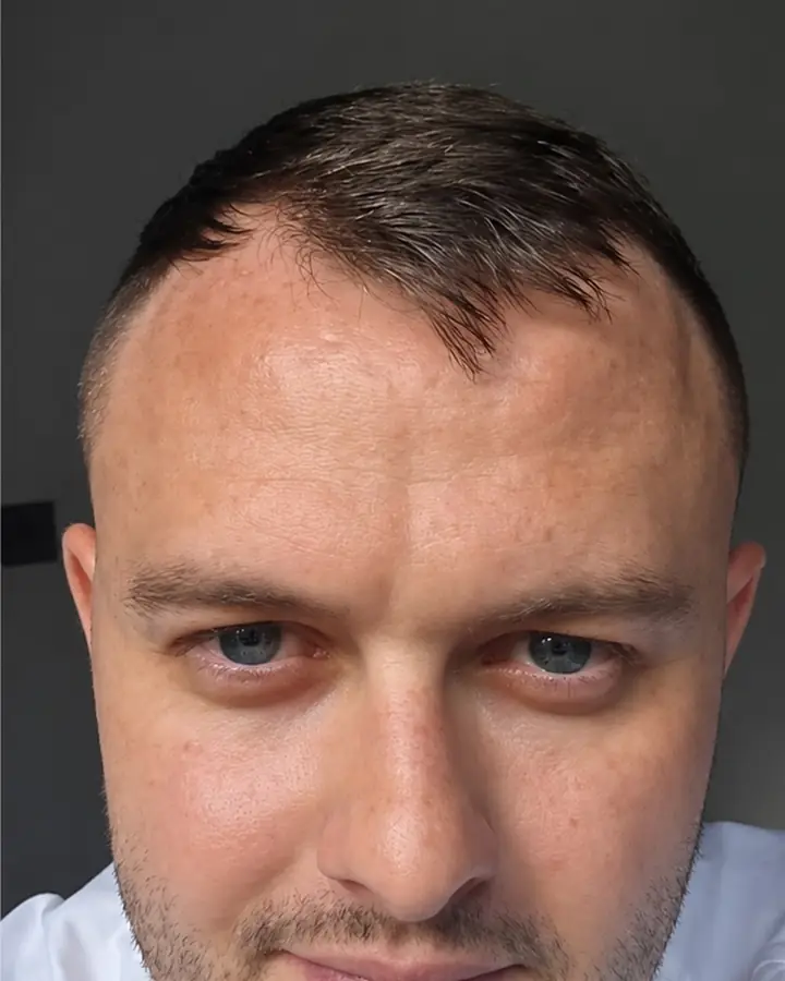 Hairline and crown, before the transplant