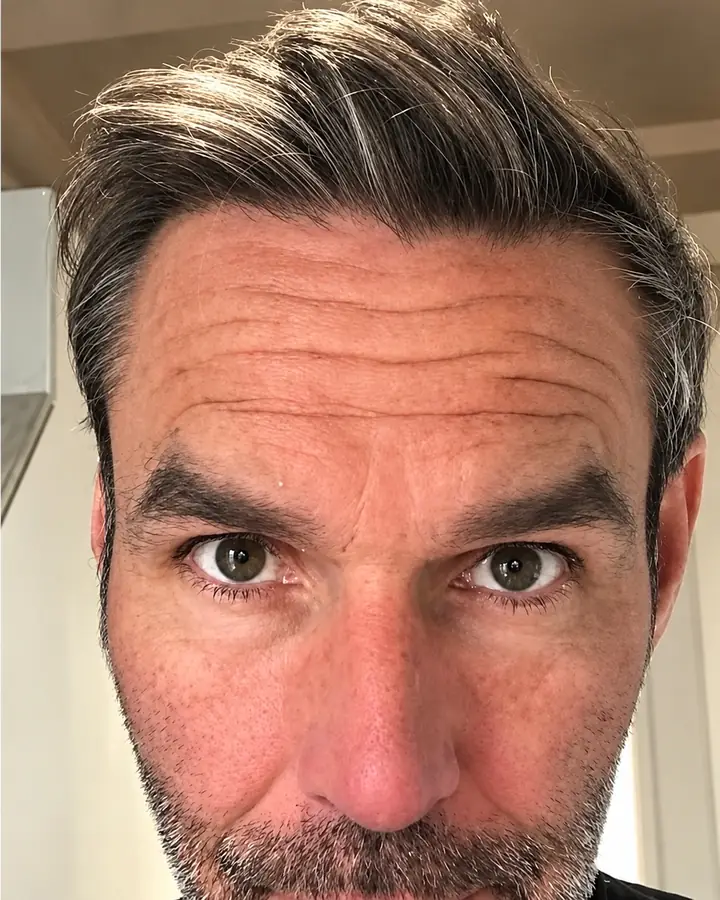 Mid-scalp, after the transplant