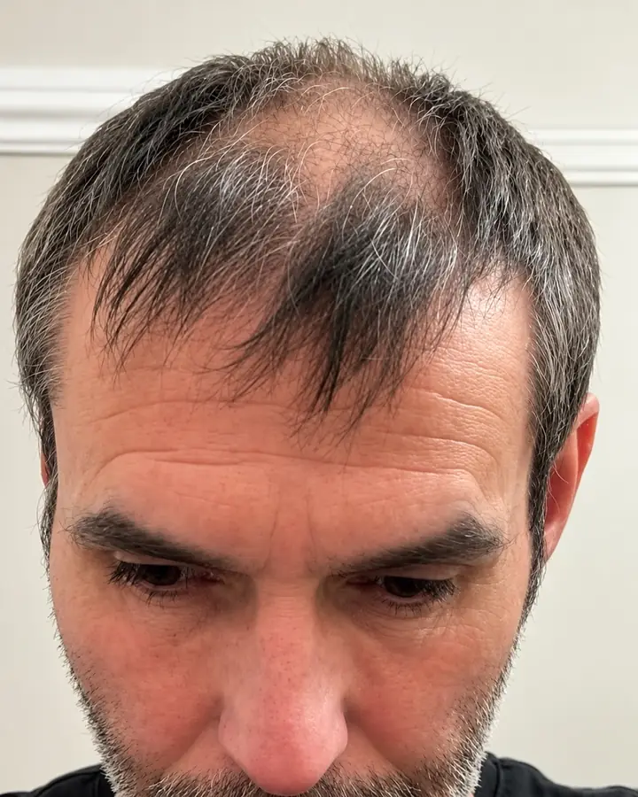 Mid-scalp, before the transplant
