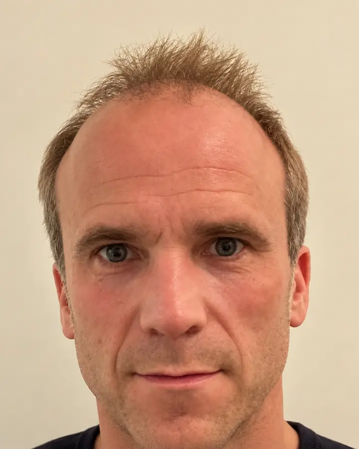 Hairline, before the transplant