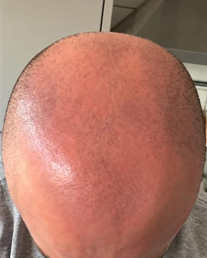Significant loss, before the transplant