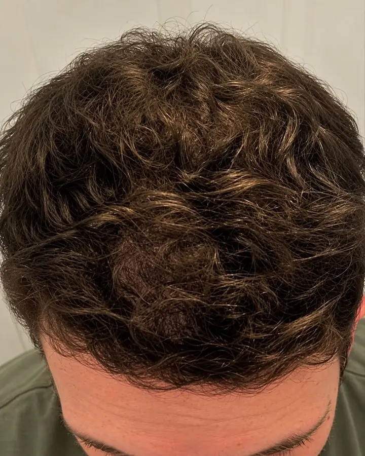 Hairline and temples, after the transplant