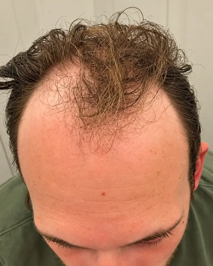 Hairline and temples, before the transplant