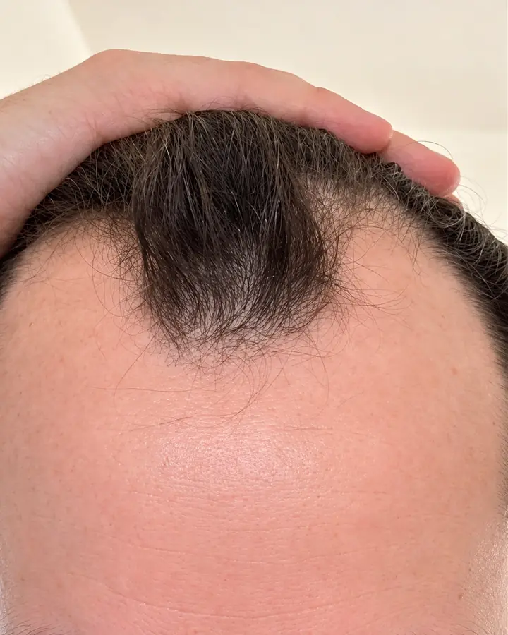 Crown, before the transplant